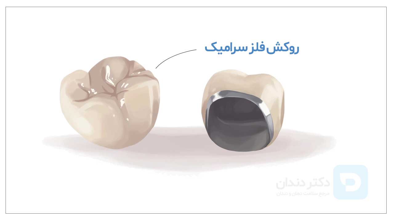عکس روکش دندان فلز سرامیکی یا pfm