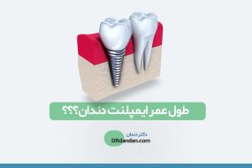 تصویر شاخص و شماتیک از ایمپلنت دندان در کنار دندان طبیعی