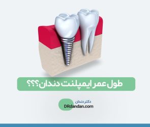 تصویر شاخص و شماتیک از ایمپلنت دندان در کنار دندان طبیعی