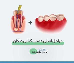 تصویر شاخص مراحل عصب کشی دندان