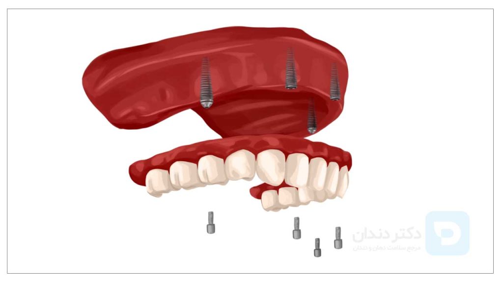 تصویر دندان مصنوعی ثابت متکی بر ایمپلنت