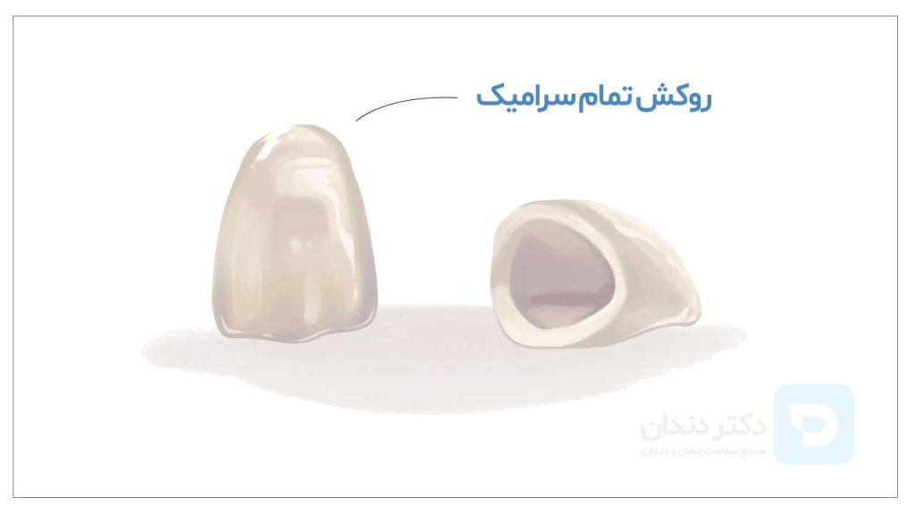 تصویر شماتیک دو عدد روکش دندان تمام سرامیک دندان همراه با قیمت روکش دندان سرامیکی