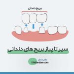 تصویر شاخص بریج دندان