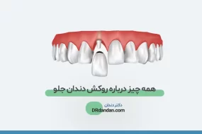 روکش دندان جلو
