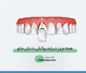 روکش دندان جلو
