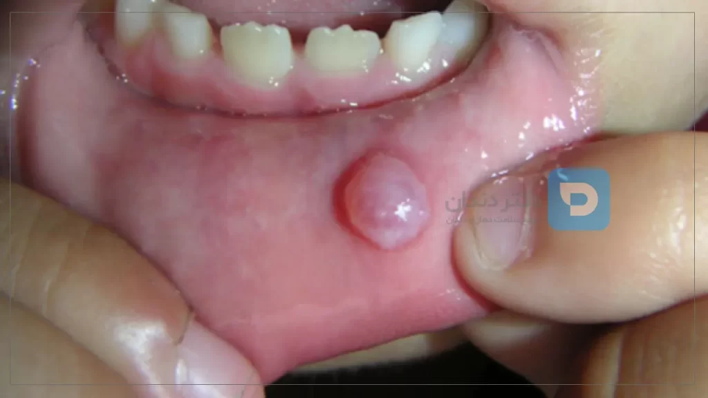 عکس یک موکوسل دهان در ناحیه داخلی لب که شبیه به تاول است