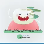 شاخص بوی دندان روکش شده