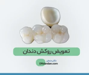زمان تعویض روکش دندان