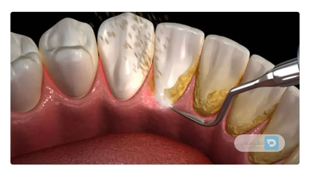 تصویر شماتیک جرمگیری دندان برای رفع بوی بد دهان