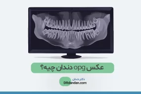 عکس دندان (شماتیک)