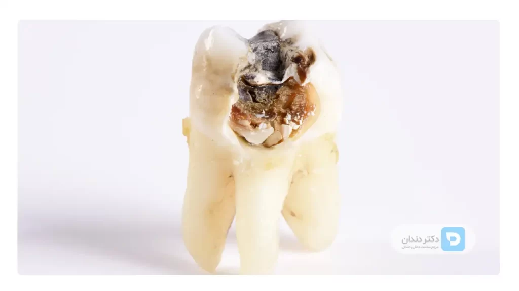 عکس واقعی یک دندان پوسیده و خراب که کشیده شده است