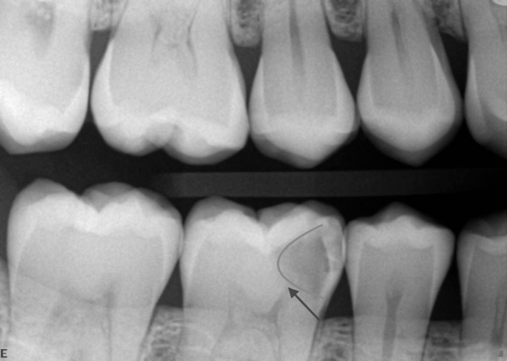 عکس پوسیدگی دندان در رادیوگرافی 