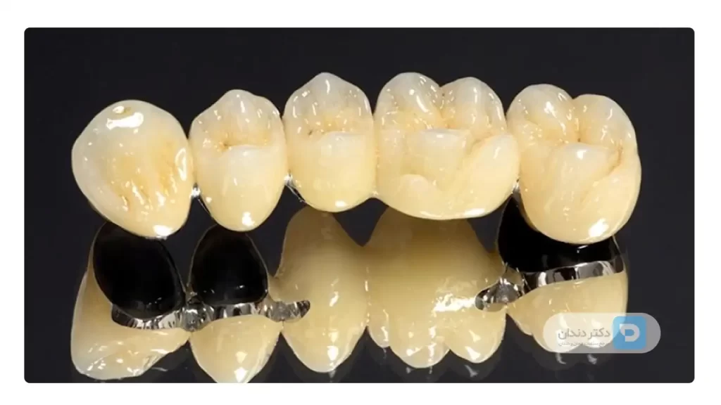 عکس 5 روکش دندان pfm متصل به هم