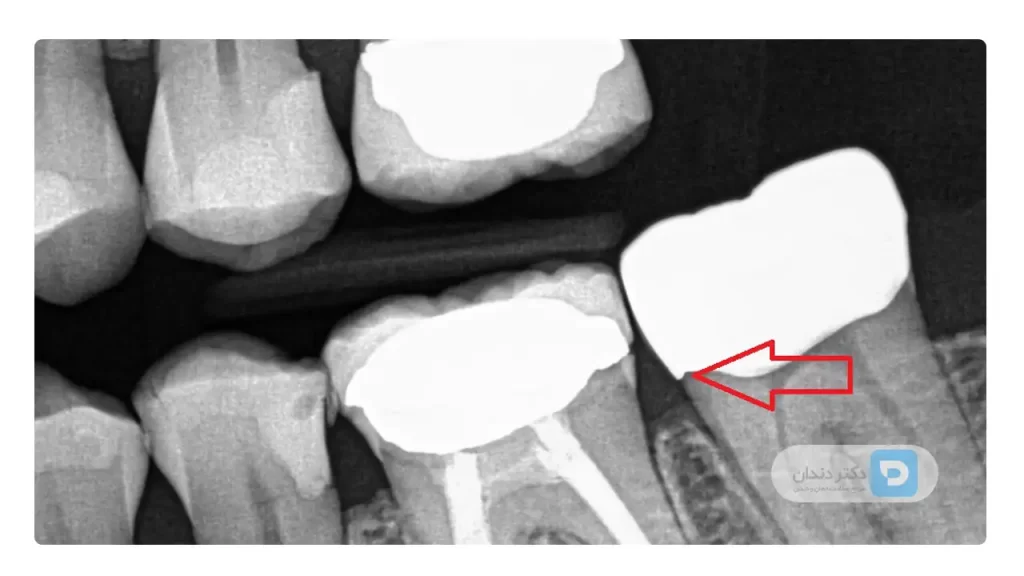 رادیوگرافی دندان روکش شده که دچار پوسیدگی شده است