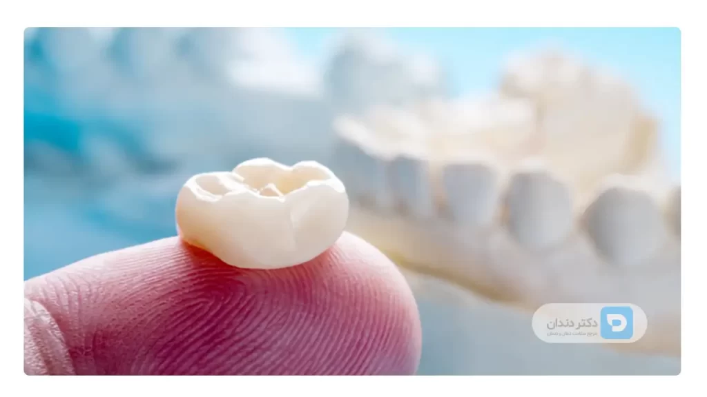 عکس روکش دندانی که افتاده و در دست یک شخص است