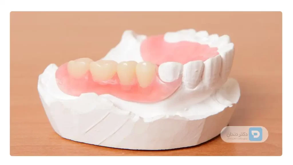 عکس دندان مصنوعی ژله ای آماده روی قالب دندان