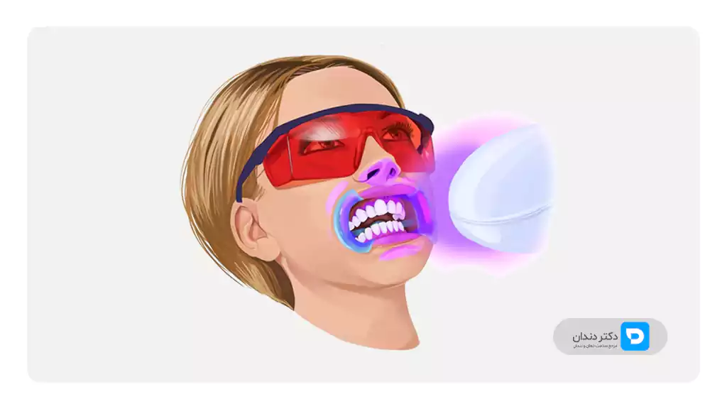 تصویر و عکس شماتیک سفید کردن دندان ها در مطب دندانپزشک