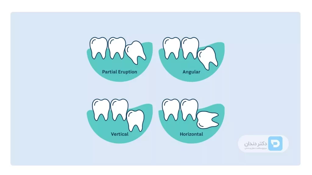 عکس شماتیک نهفتگی دندان عقل/ دندان عقل ممکن است به 4 حالت نهفته باشد و موجب درد شود