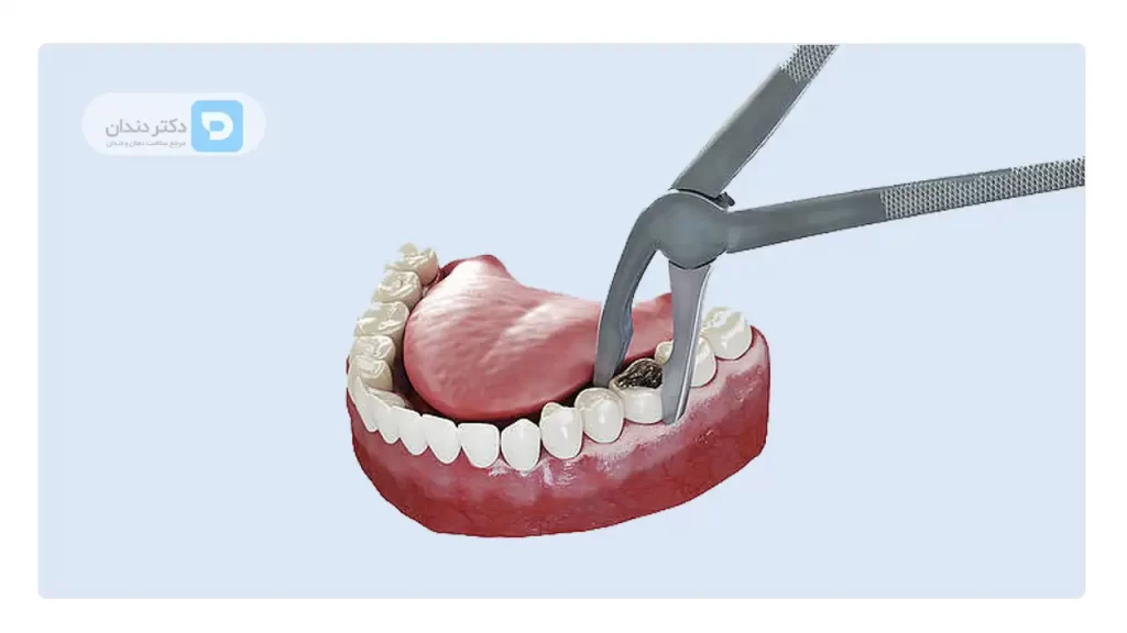 عکس شماتیک کشیدن دندان