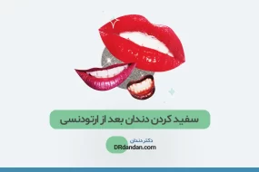 سفید کردن دندان ها بعد از ارتودنسی
