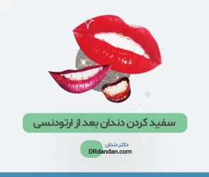 سفید کردن دندان ها بعد از ارتودنسی